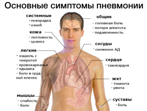 Скрытая или бессимптомная пневмония – как распознать опасное заболевание