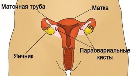 Способы лечения параовариальной кисты яичника