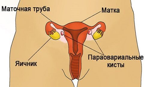 Способы лечения параовариальной кисты яичника