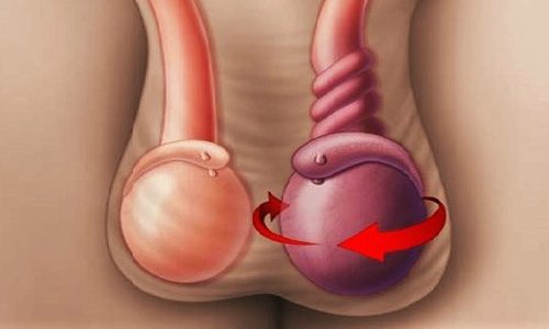 Способы лечения и последствия перекрута яичка у мужчин