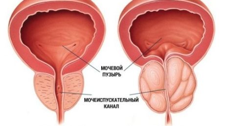Способы применения конского каштана от простатита