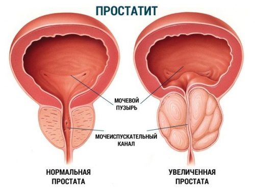 Способы применения конского каштана от простатита