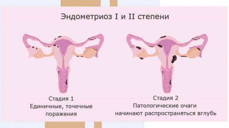 Стадии эндометриоза матки и их симптоматические проявления