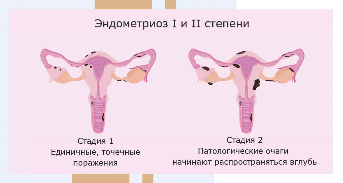 Стадии эндометриоза матки и их симптоматические проявления