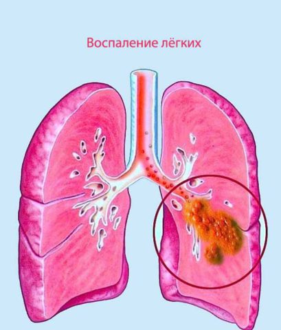 Стафилококковая пневмония – опасная болезнь, которая может убить