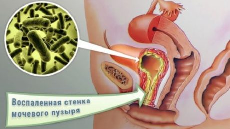Связь между циститом и овуляцией