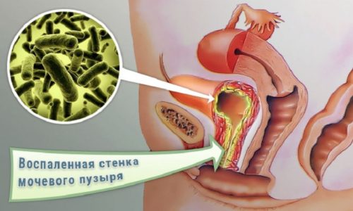 Связь между циститом и овуляцией