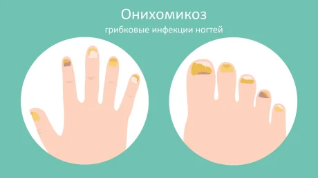 Теперь грибок лечить легко!