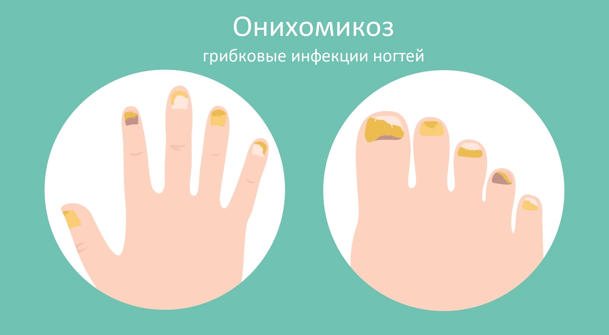 Теперь грибок лечить легко!