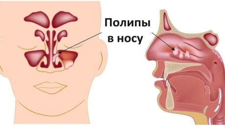 Устранение полипов в носу