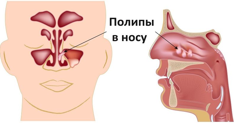 Устранение полипов в носу
