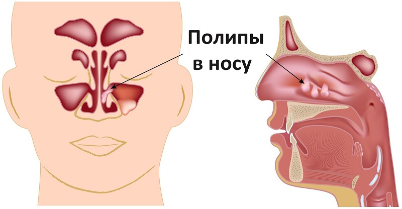 Устранение полипов в носу