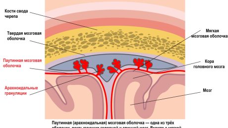 Воспаление паутинного слоя головного мозга